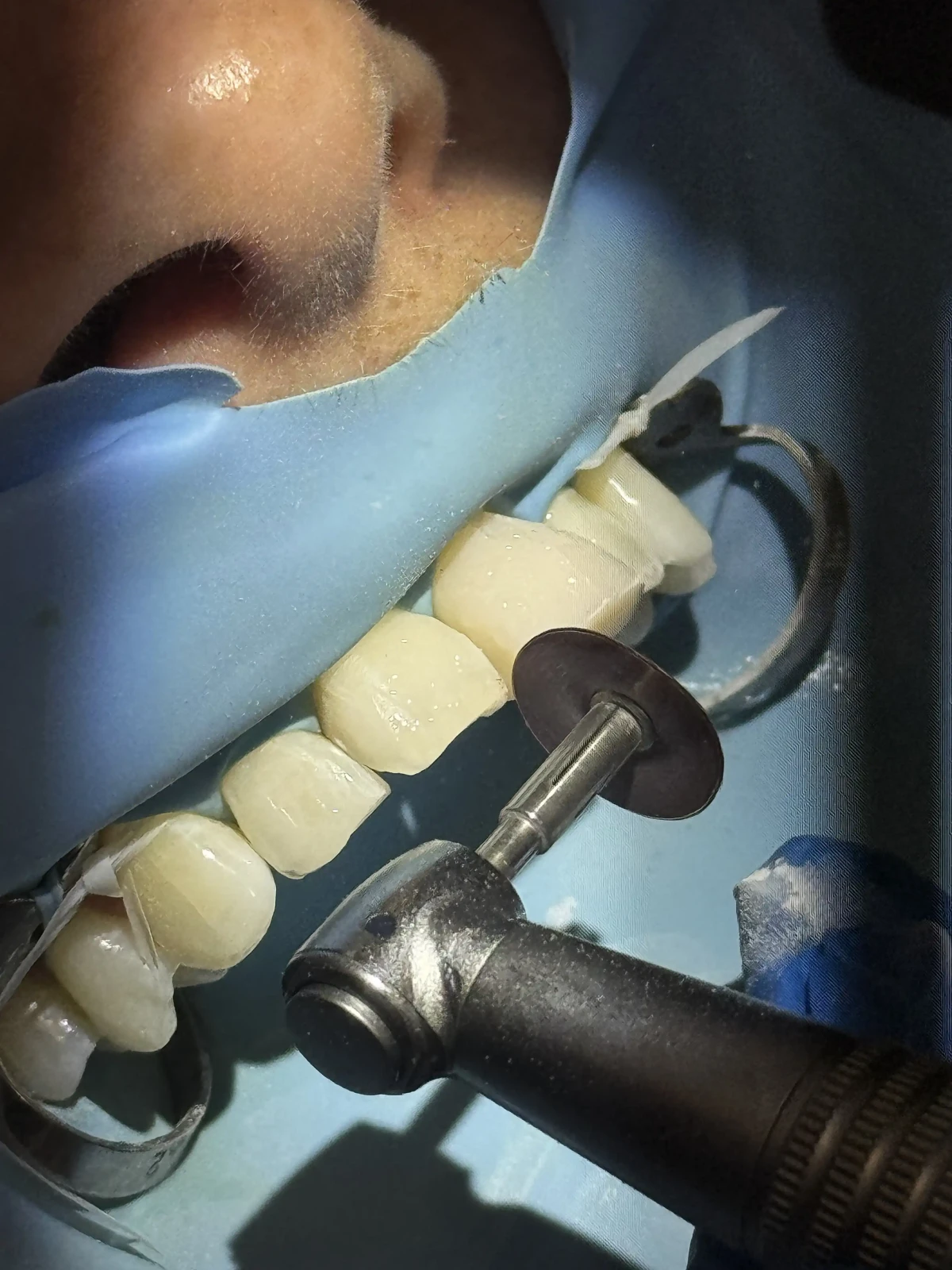 Teeth moulding scaled