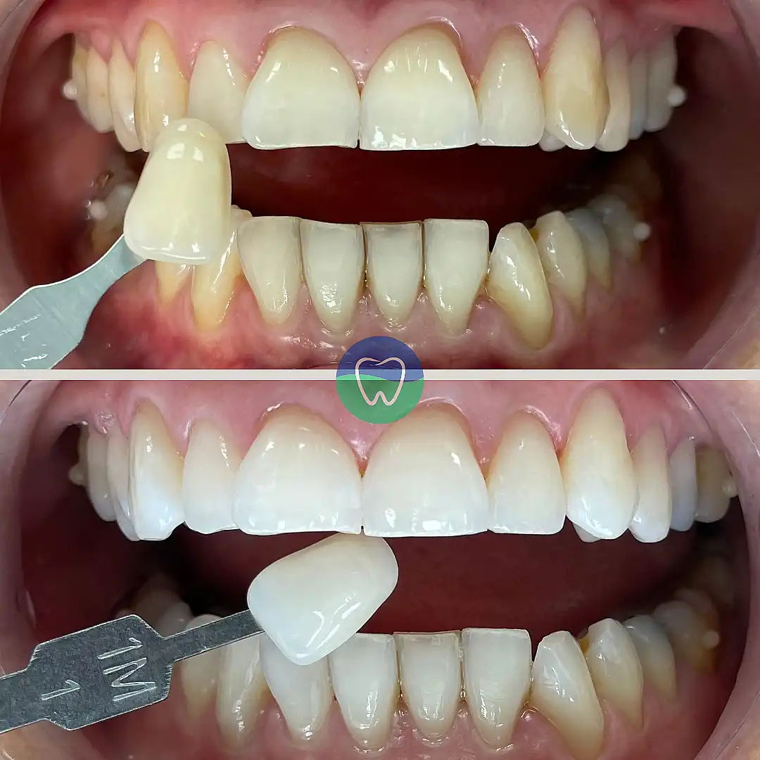 Teeth whitening